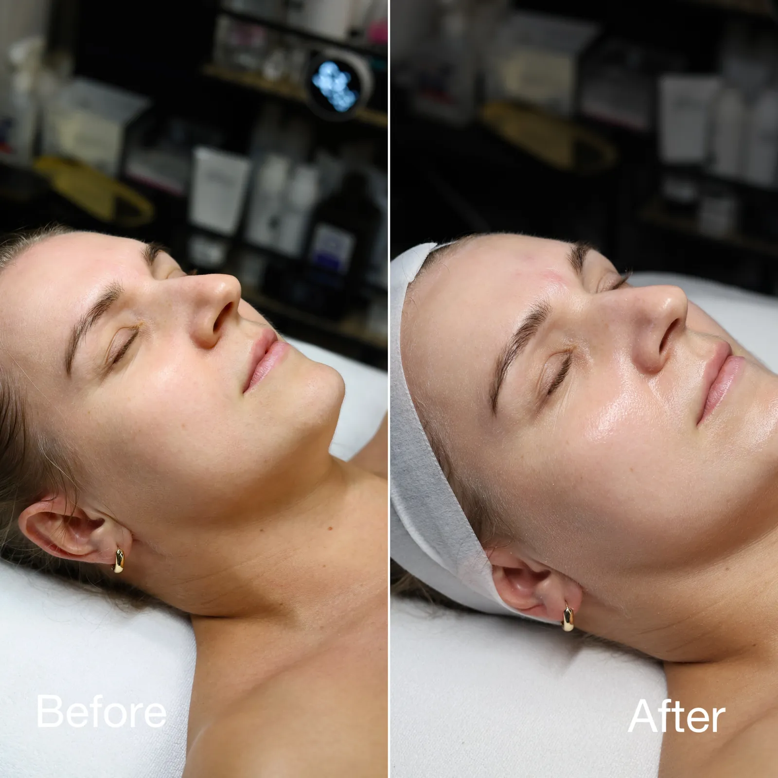 Signature Facial — After